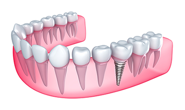 Dental Implants Milford